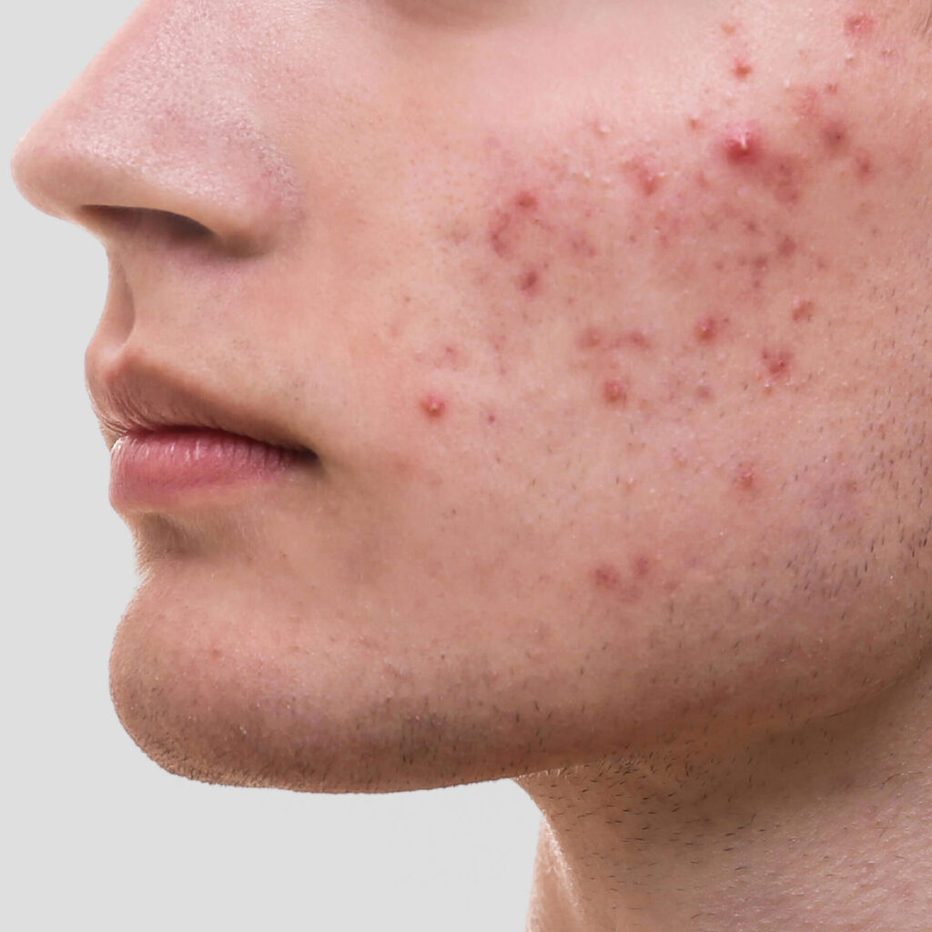 acne treatment in Vancouver BC