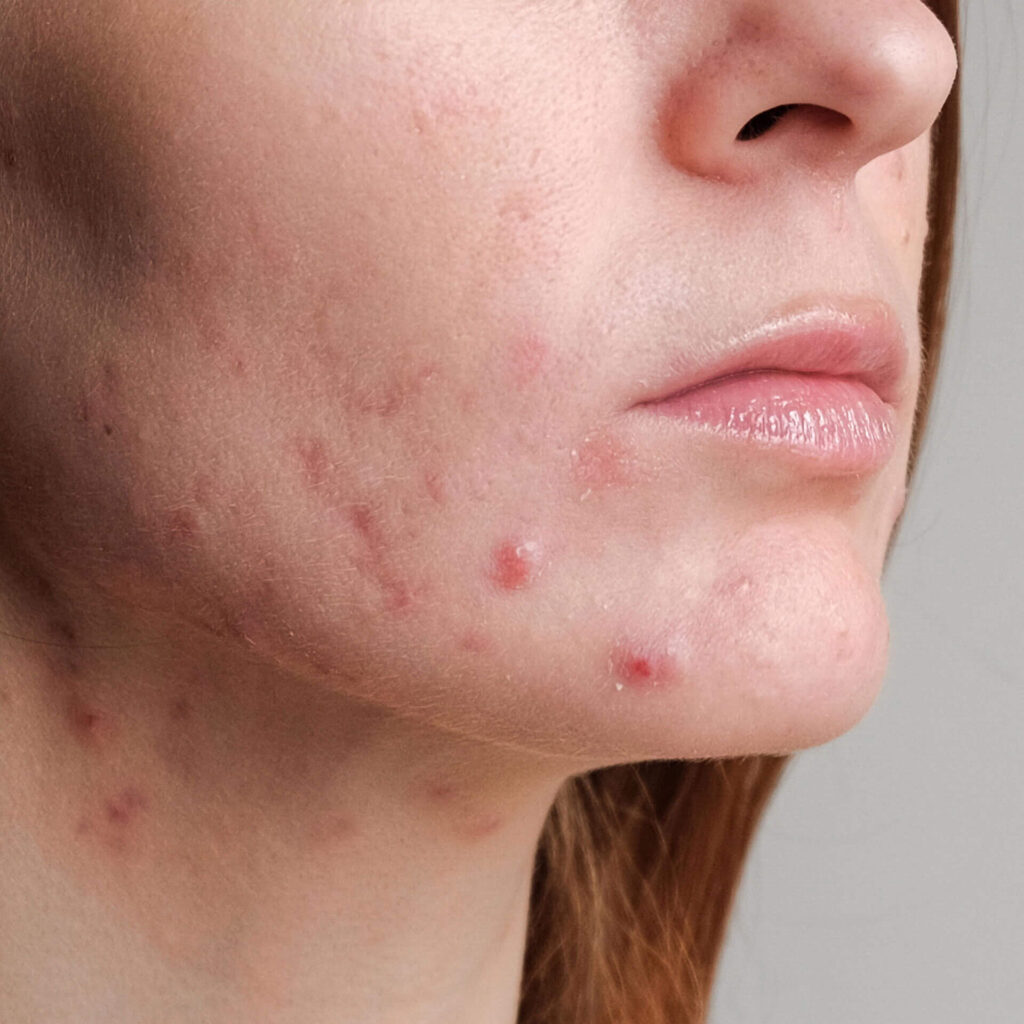 Acne removal in Vancouver BC