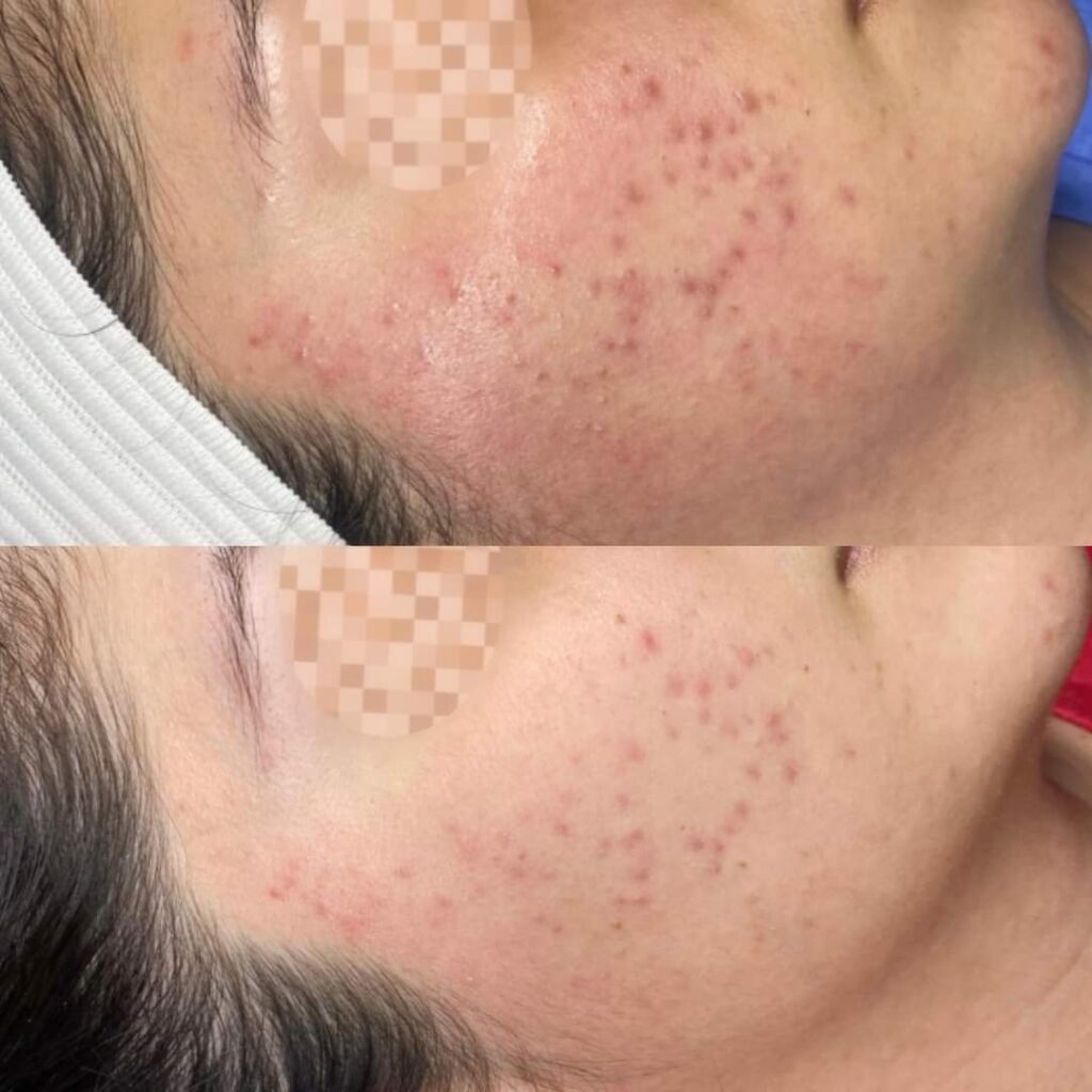 BioRePeel CL3 before and after